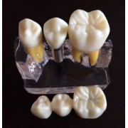 Implant Demonstration Training Model (Transparent)