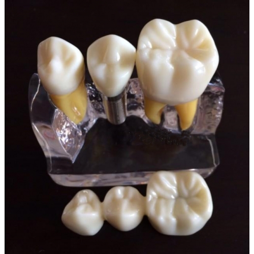 Implant Demonstration Training Model (Transparent)